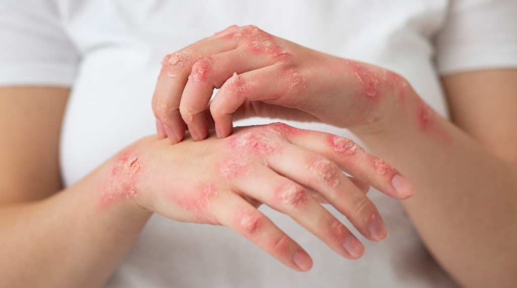 Decoding Skin Allergies