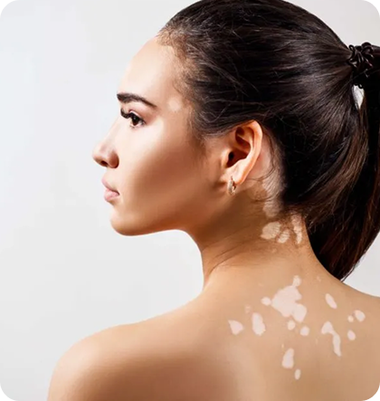 Vitiligo Treatment in Abu Dhabi at Wellness One Day Surgery Center