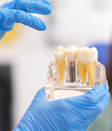 Best Dental Implant in Abu Dhabi